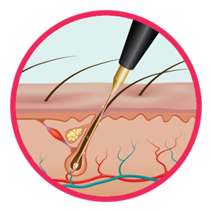 Electrolysis  Photo